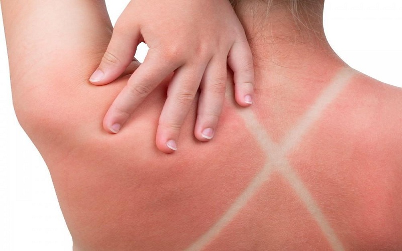 Sunburns And Dermatology