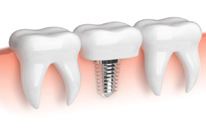 Cost of Dental Implants